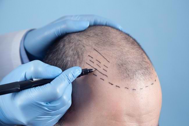 Daftar Harga Transplantasi Rambut Serta Efek Sampingnya